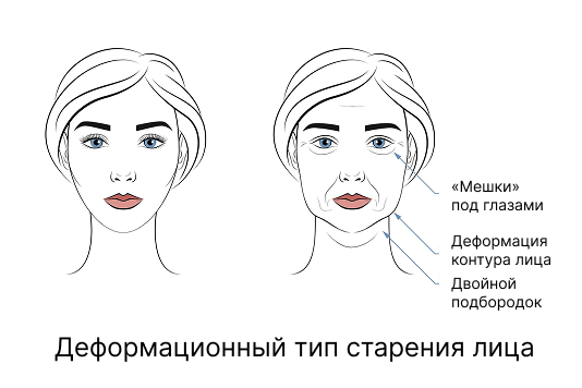 Деформационный тип старения