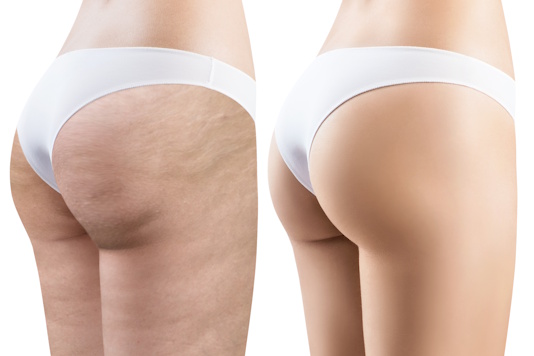 Стадии целлюлита