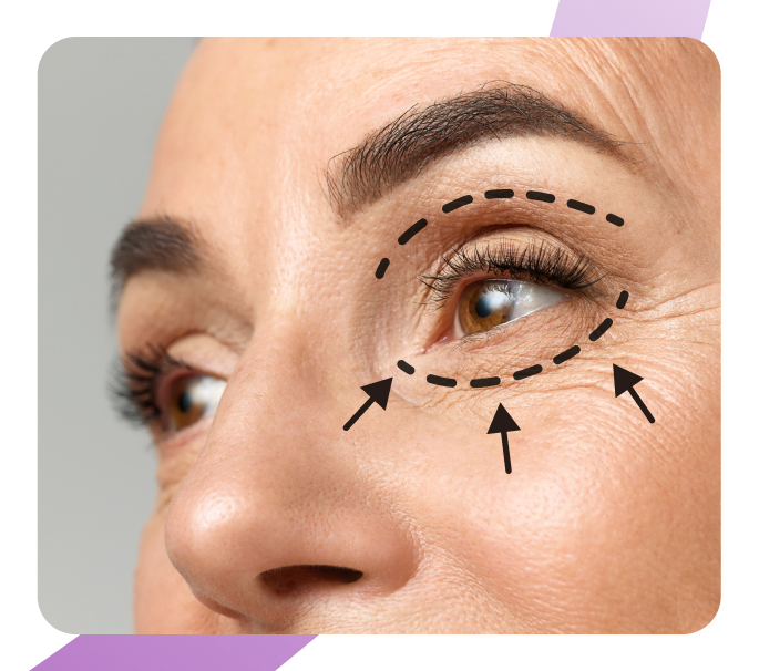 Круговая блефаропластика – Пластика лица и шеи, фото