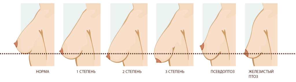 Степени птоза груди