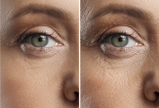 Мелкоморщинистый тип старения кожи Мелкоморщинистый тип старения кожи