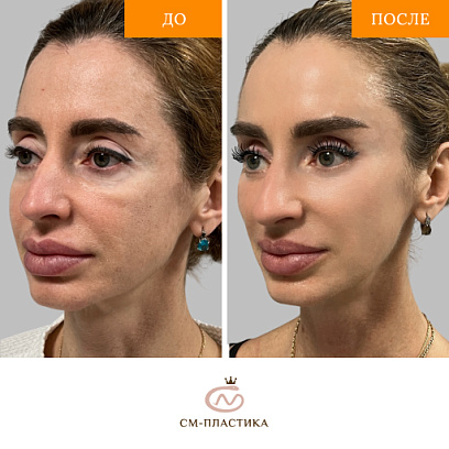 Эндоскопический лобновисочный лифтинг, верхняя и нижняя блефаропластика, лифтинг средней трети лица
