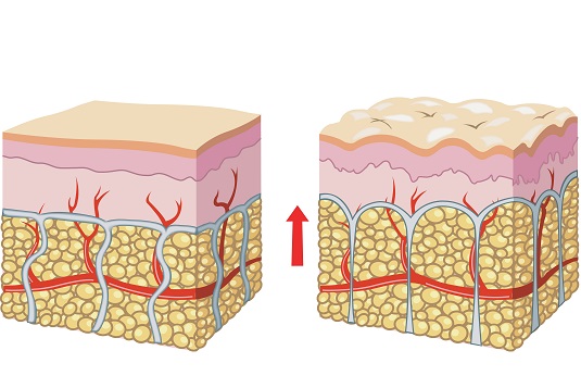 Причины целлюлита Причины целлюлита